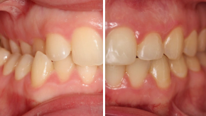 Clear braces before and after smile transformation