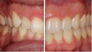 Invisalign before and after smile transformation