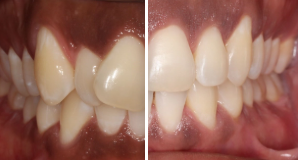 Metal braces before and after smile transformation
