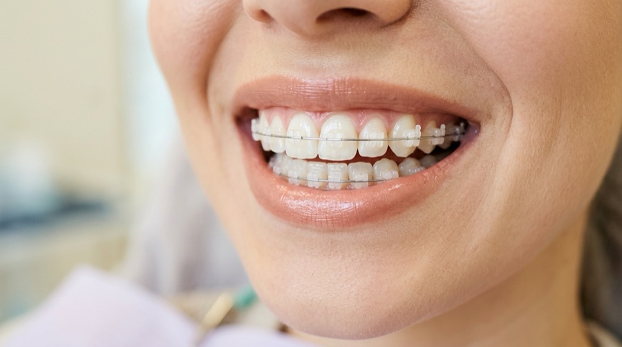 Clear Ceramic Braces